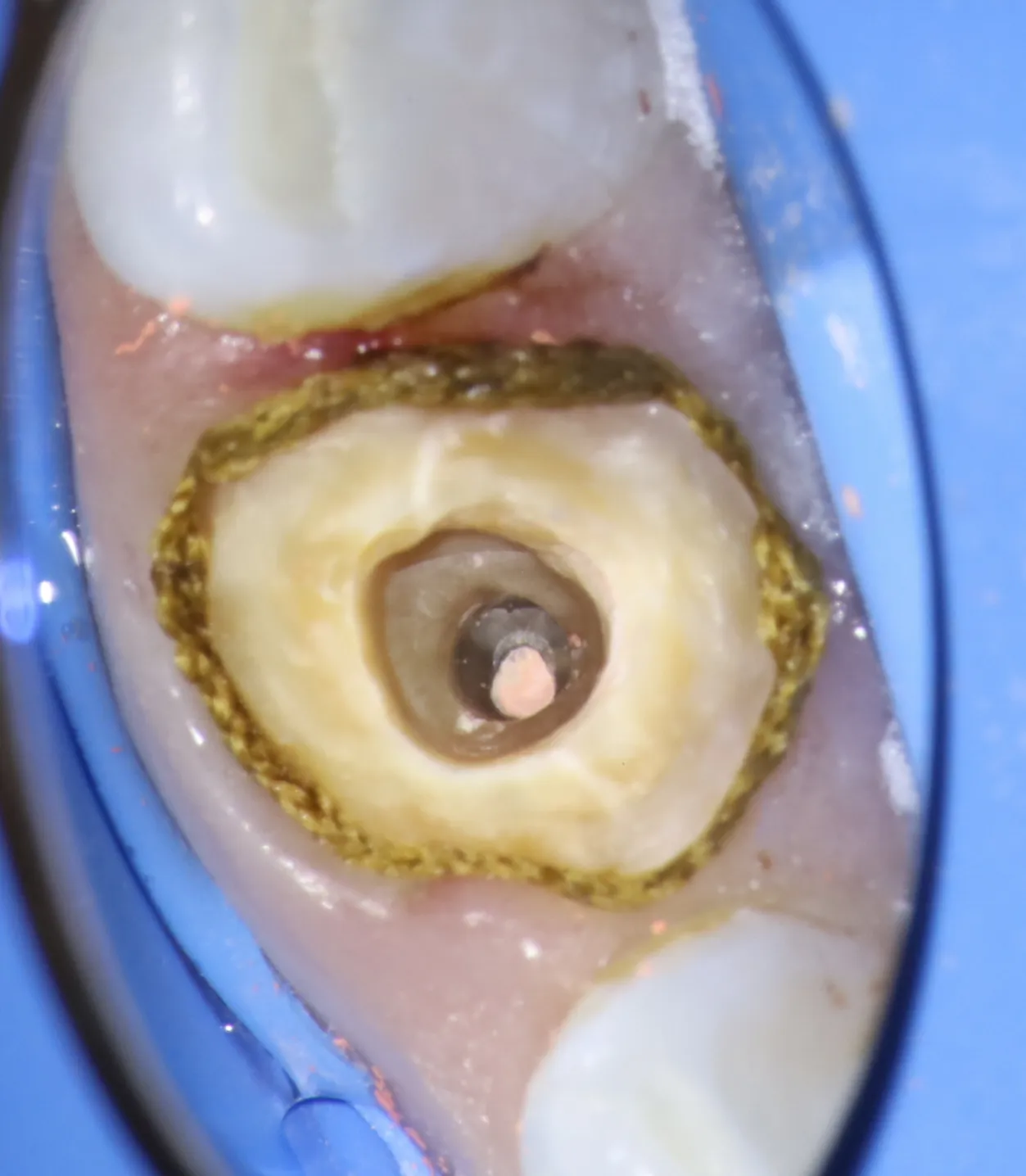 Working length radiograph during retreatment showing improved canal obturation